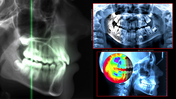 An x-ray which is a crucial aspect of the Dental Implant Placement Process in Barrie, Ontario